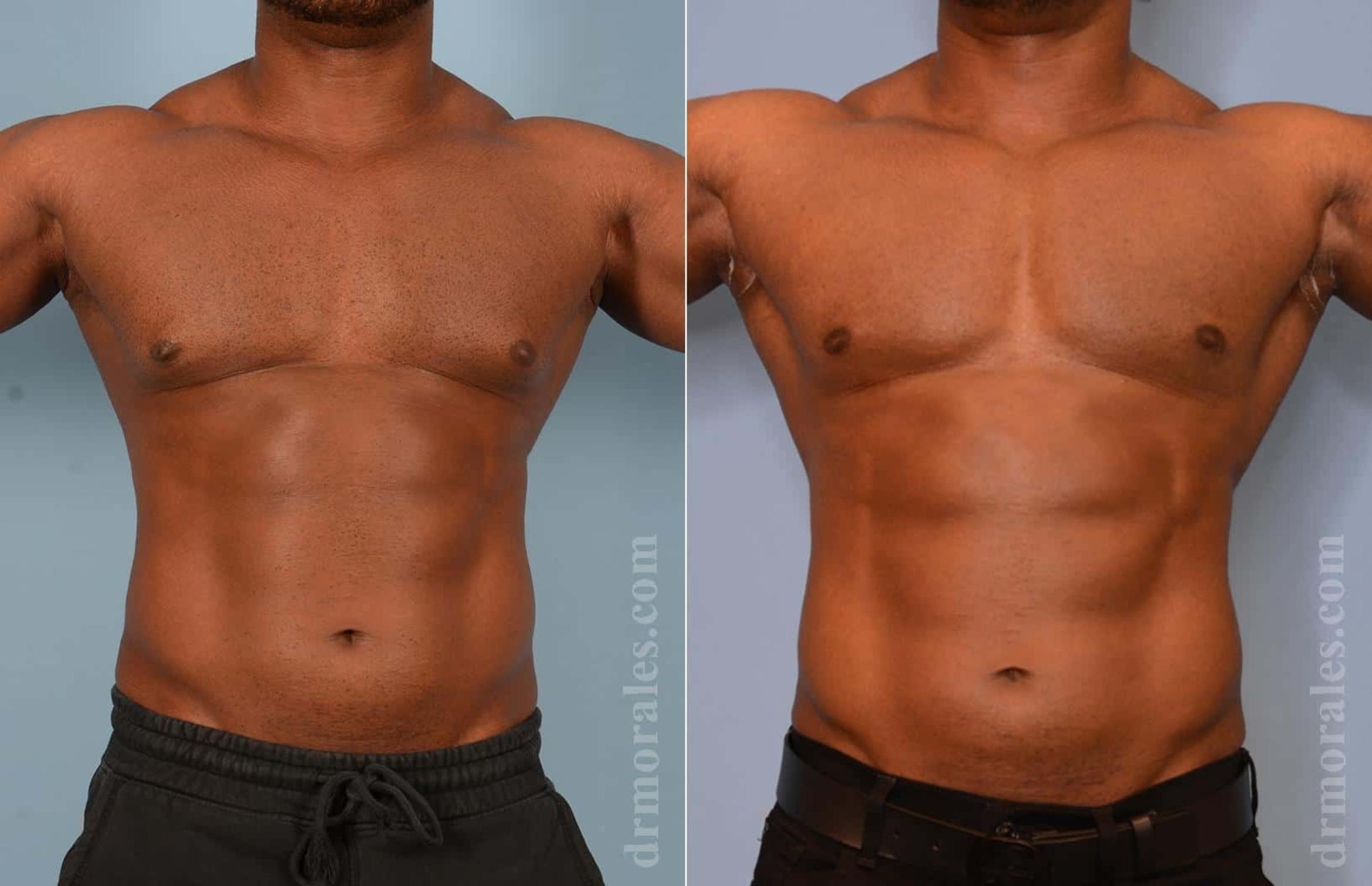 Before & After Gynecomastia Case 16 View 1 View in Houston, TX