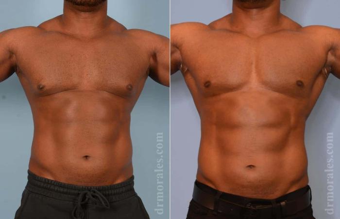 Before & After Gynecomastia Case 16 View 1 View in Houston, TX