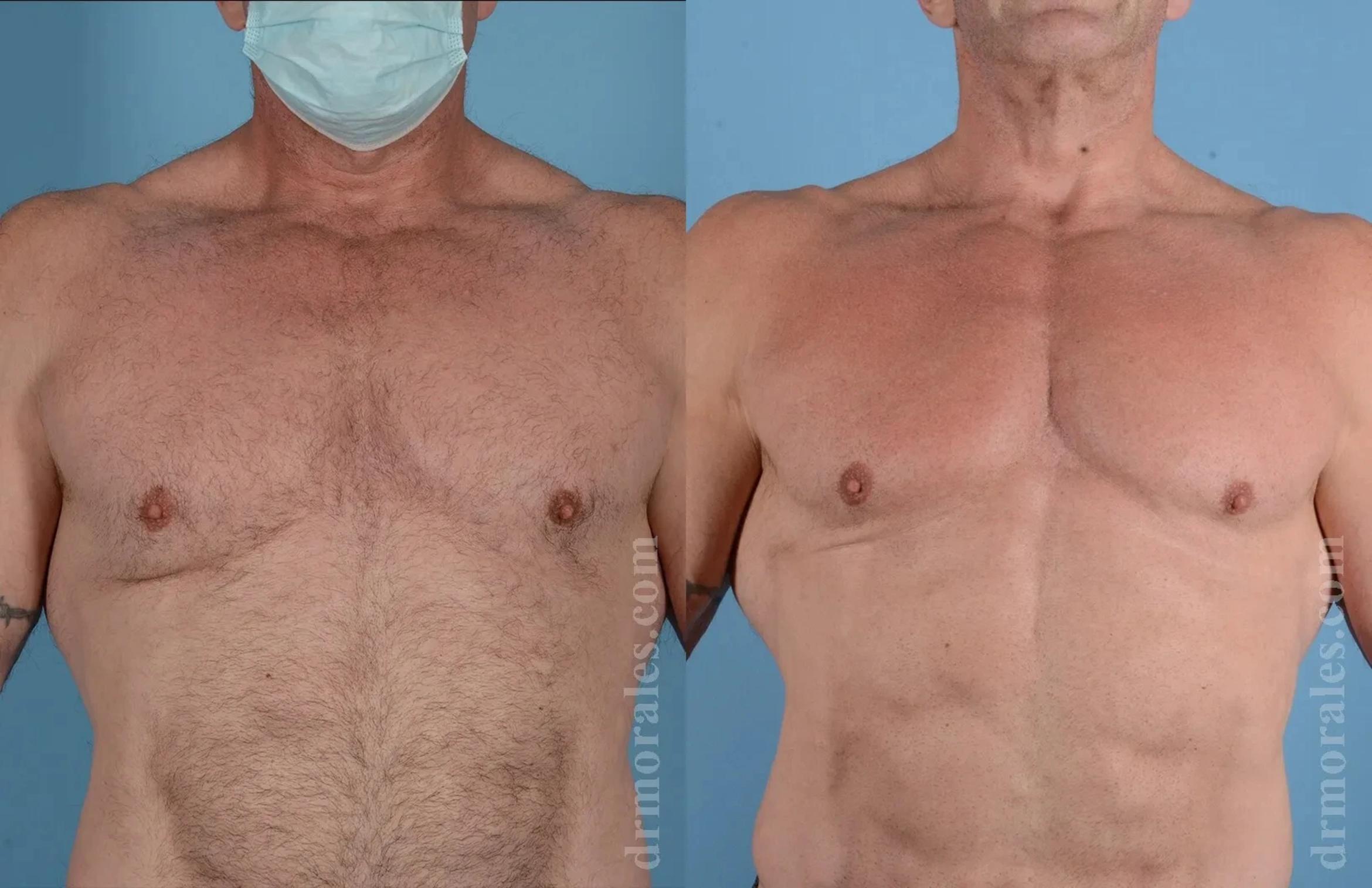 Before & After Gynecomastia Case 160 View 1 View in Houston, TX