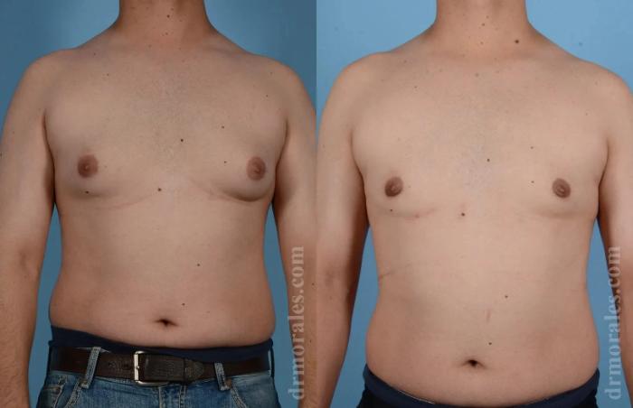 Before & After Gynecomastia Case 161 View 1 View in Houston, TX