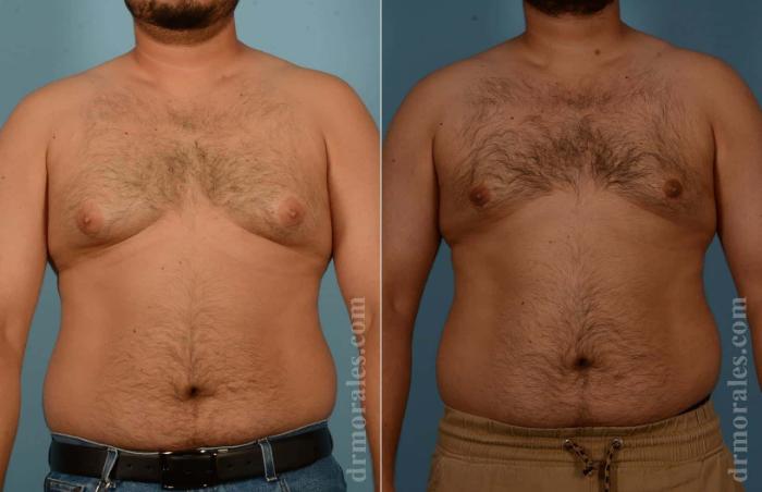 Before & After Gynecomastia Case 3 View 1 View in Houston, TX