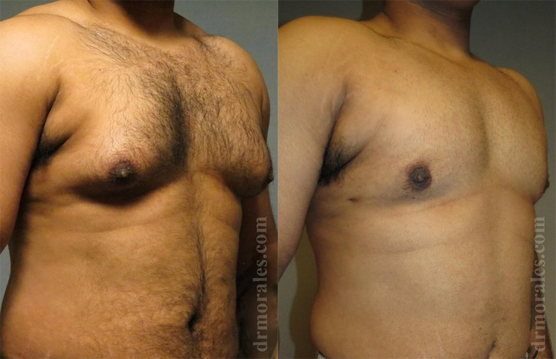 Before & After Gynecomastia Case 434 View 1 View in Houston, TX