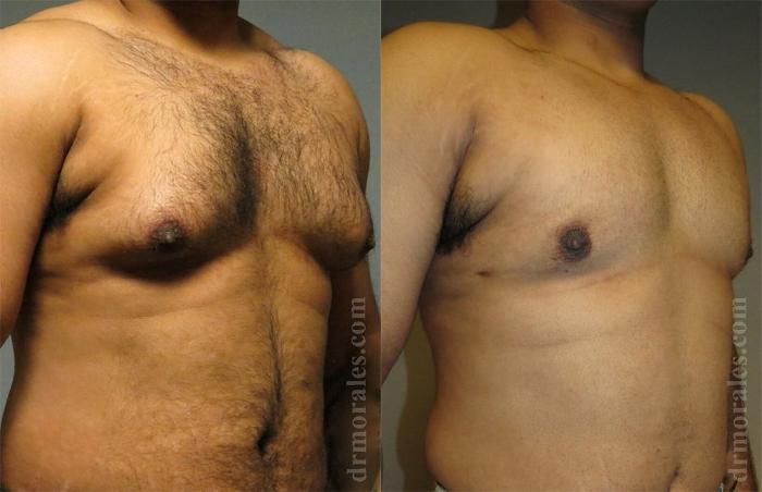 Before & After Gynecomastia Case 434 View 1 View in Houston, TX