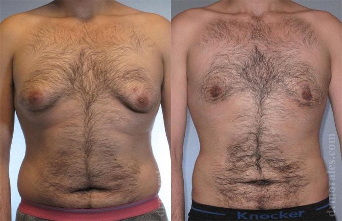 Before & After Gynecomastia Case 446 View 1 View in Houston, TX