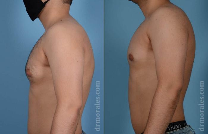 Before & After Gynecomastia Case 81 View 1 View in Houston, TX
