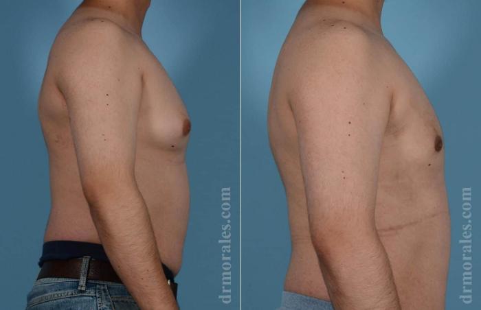 Before & After Gynecomastia Case 82 View 1 View in Houston, TX