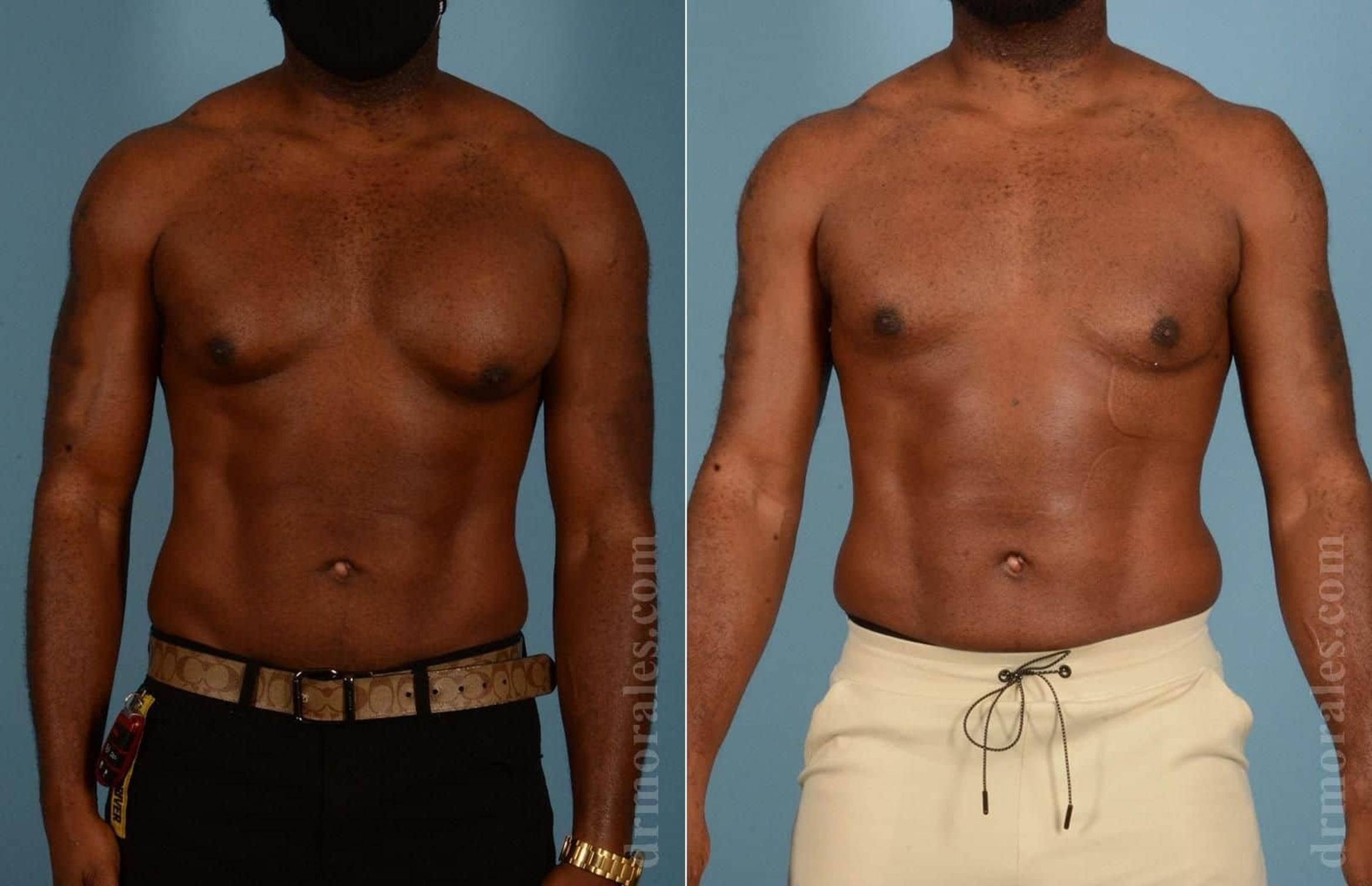 Before & After Gynecomastia Case 83 View 1 View in Houston, TX