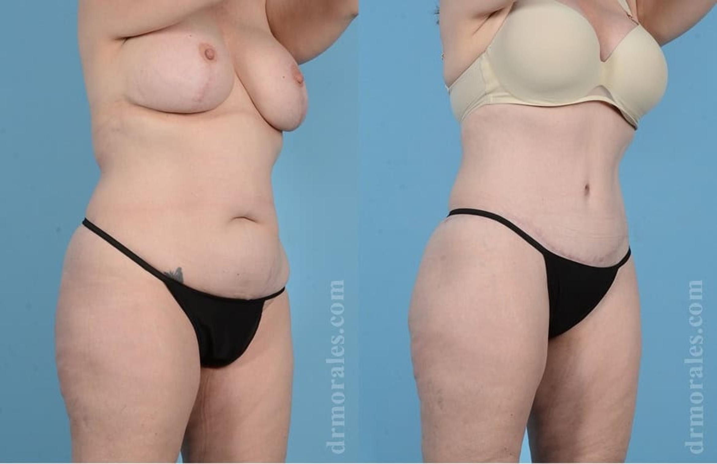 Before & After Liposuction Case 37 View 1 View in Houston, TX