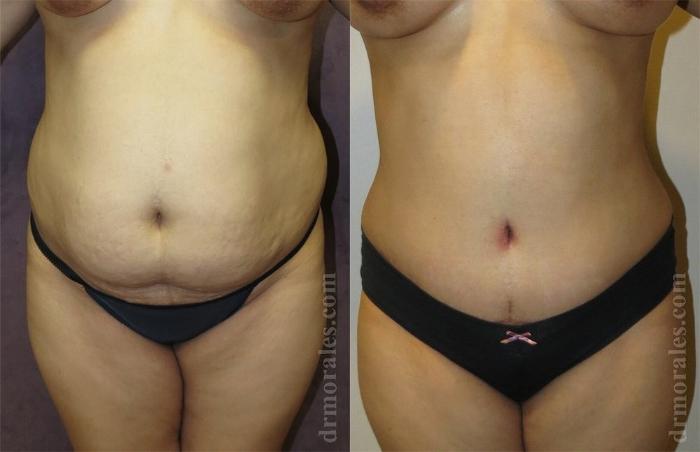 Before & After Liposuction Case 411 View 1 View in Houston, TX