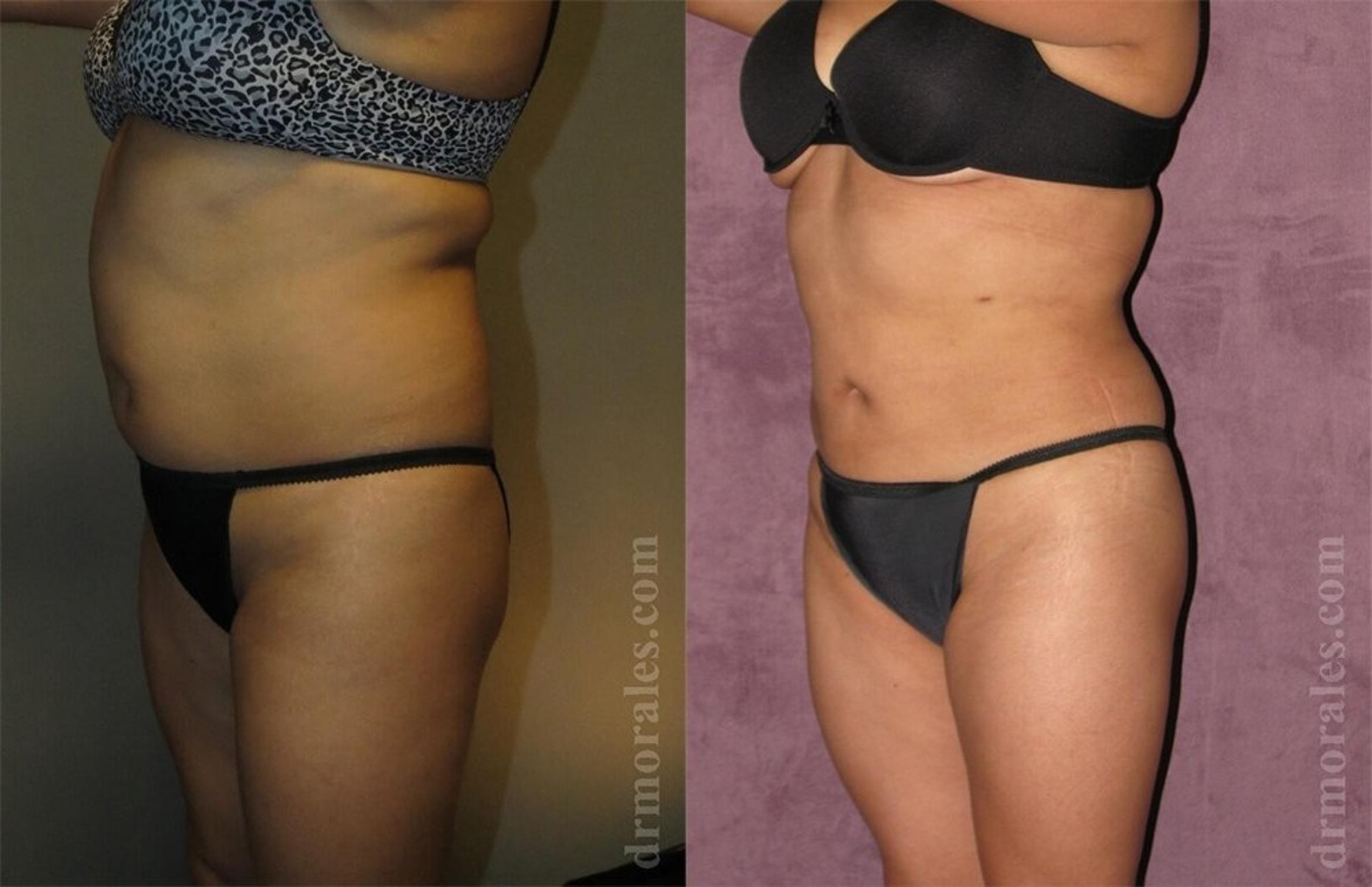 Before & After Liposuction Case 412 View 1 View in Houston, TX