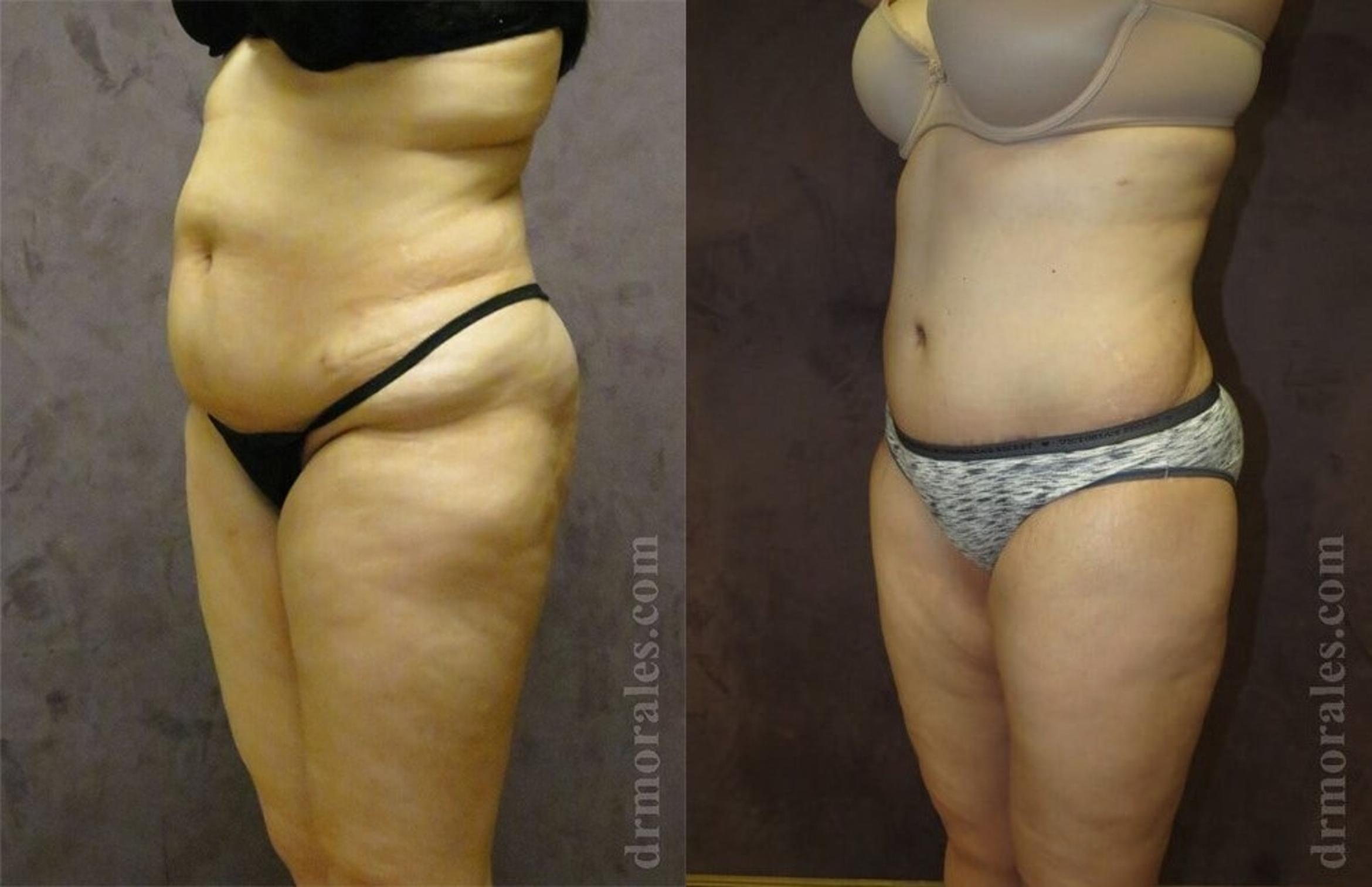 Before & After Tummy Tuck Case 413 View 1 View in Houston, TX