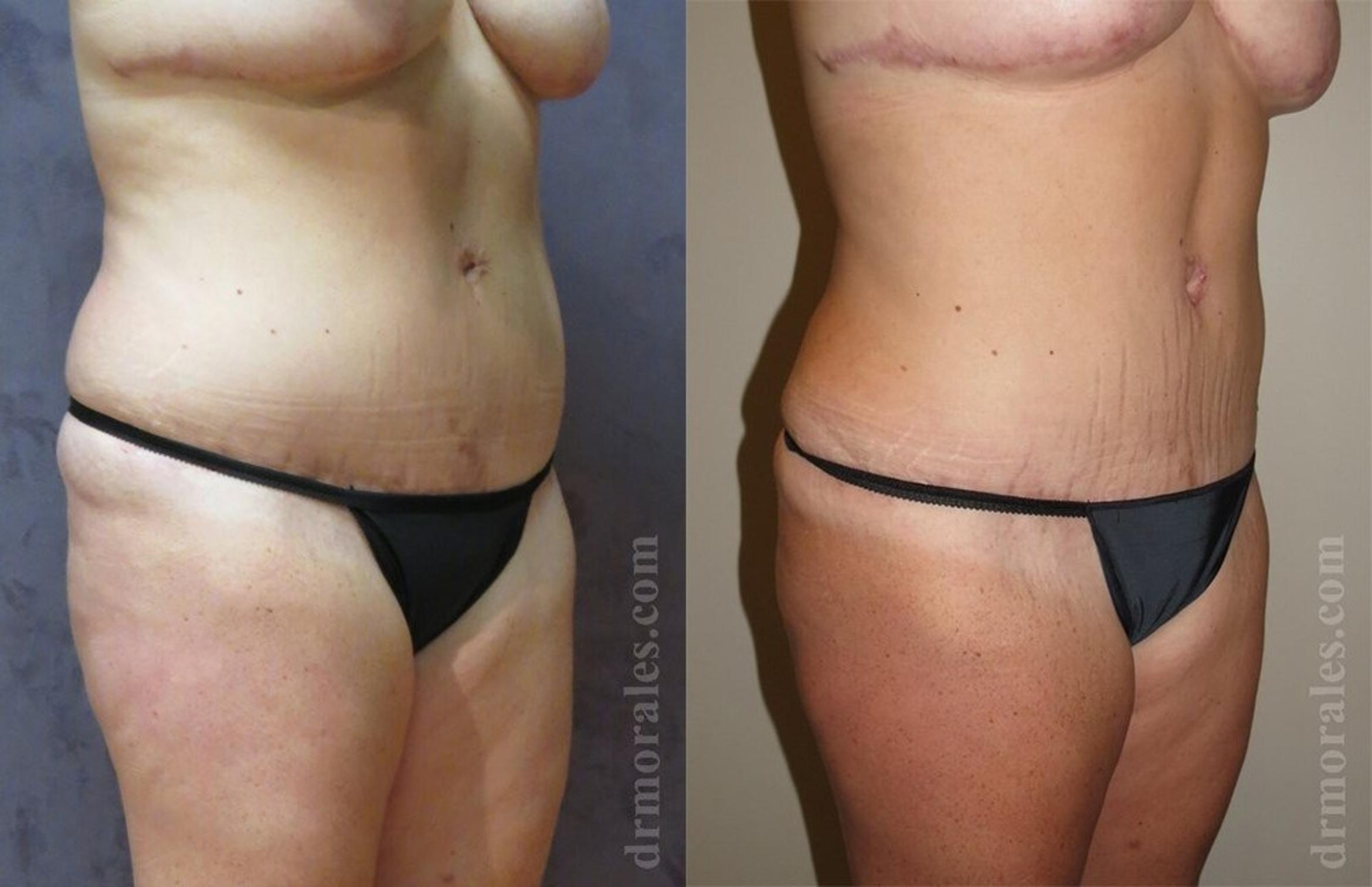 Before & After Liposuction Case 414 View 1 View in Houston, TX