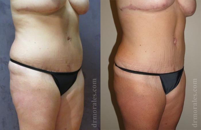 Before & After Liposuction Case 414 View 1 View in Houston, TX