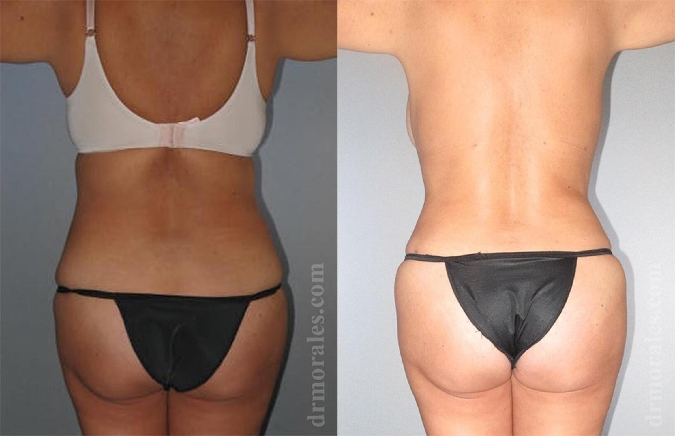 Before & After Liposuction Case 415 View 1 View in Houston, TX