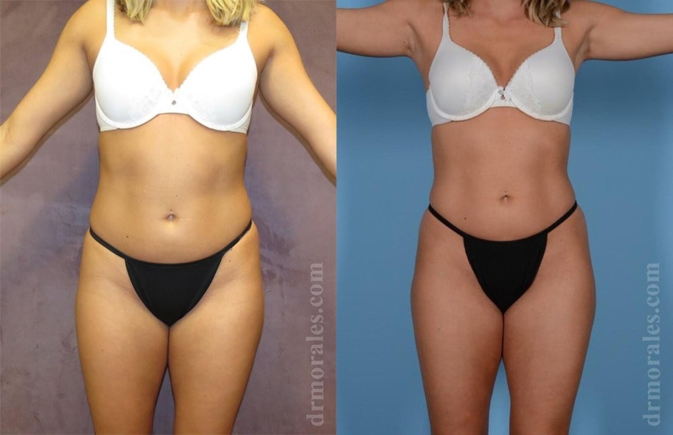 Before & After Liposuction Case 416 View 1 View in Houston, TX