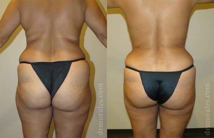 Before & After Liposuction Case 417 View 1 View in Houston, TX