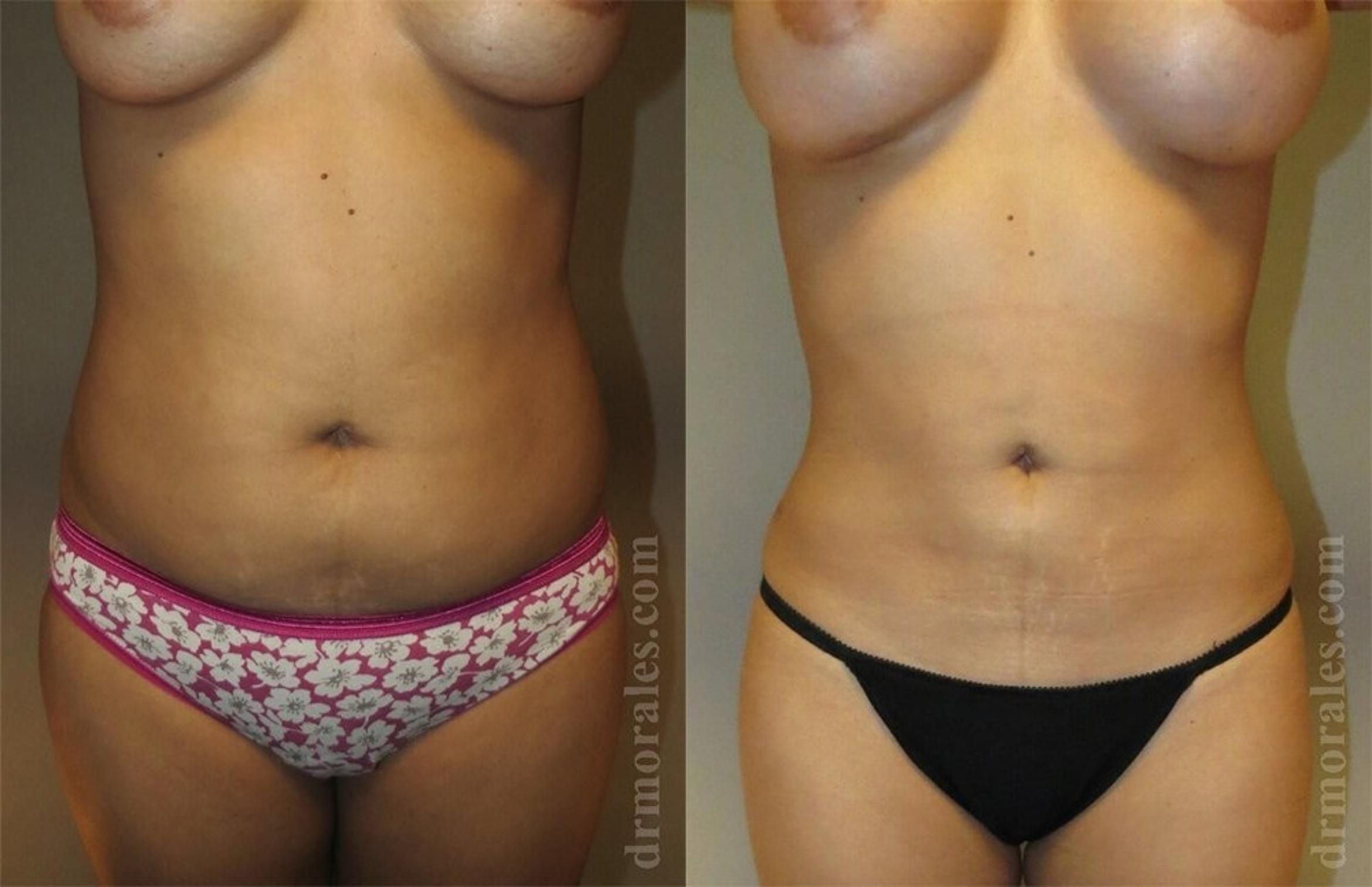 Before & After Liposuction Case 419 View 1 View in Houston, TX