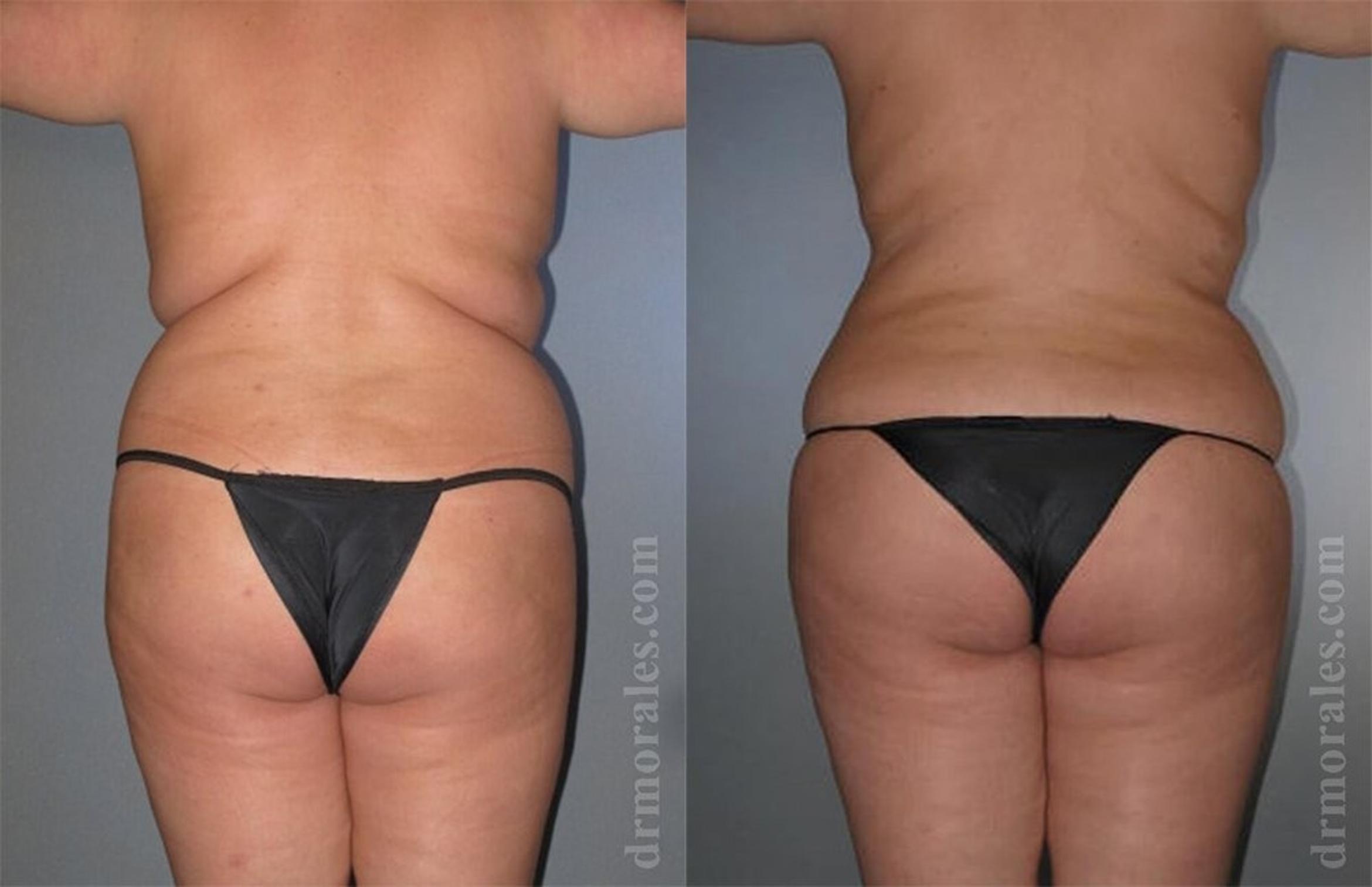 Before & After Liposuction Case 420 View 1 View in Houston, TX