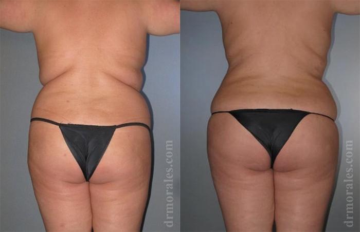 Before & After Liposuction Case 420 View 1 View in Houston, TX