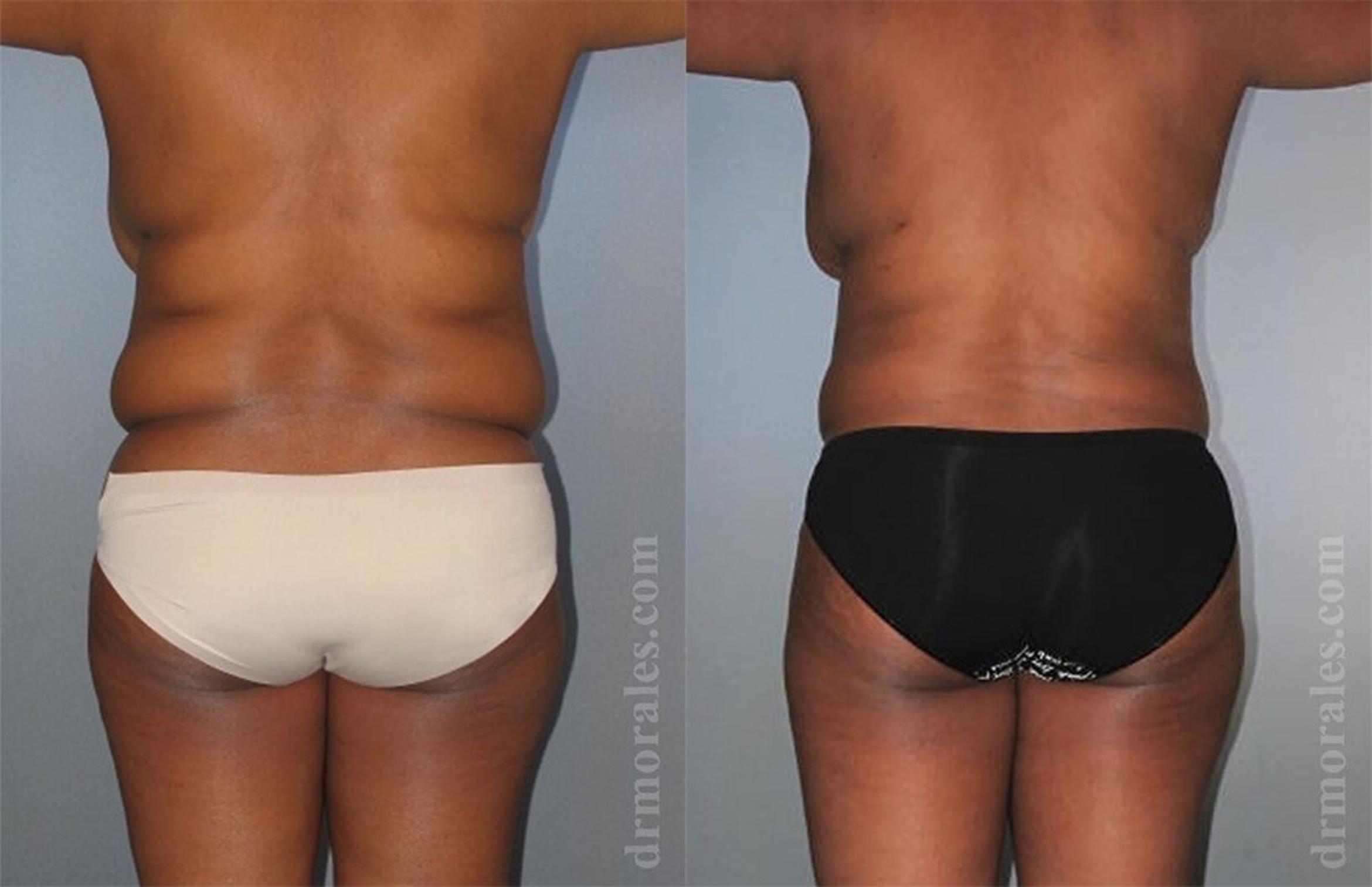 Before & After Liposuction Case 421 View 1 View in Houston, TX