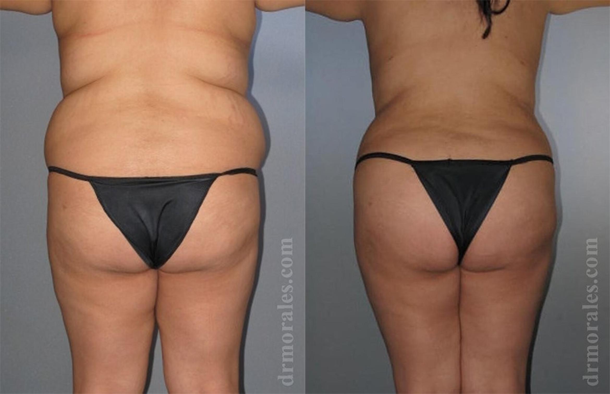 Before & After Liposuction Case 422 View 1 View in Houston, TX