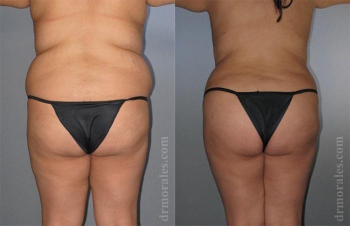 Before & After Liposuction Case 422 View 1 View in Houston, TX