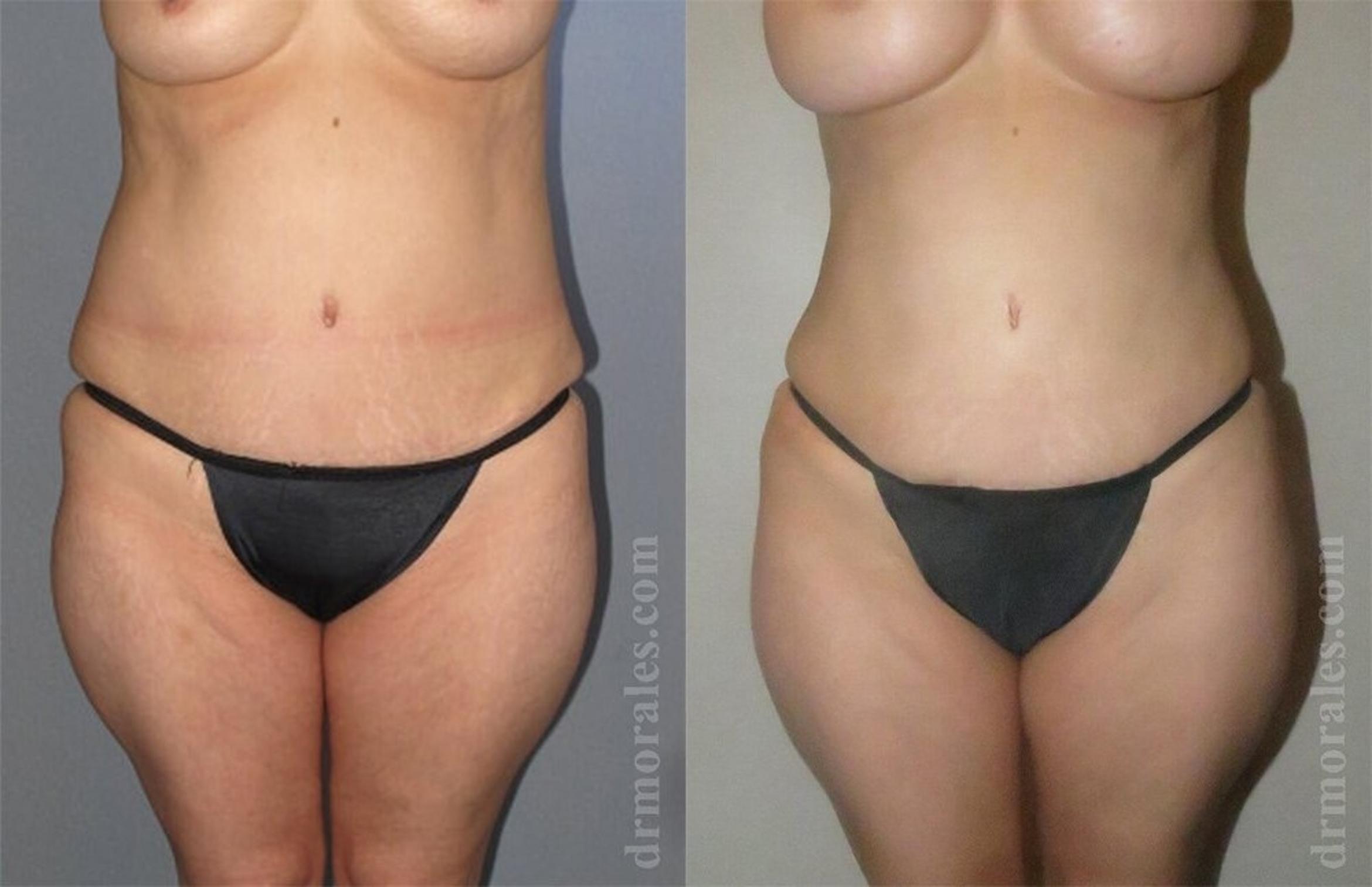 Before & After Liposuction Case 423 View 1 View in Houston, TX