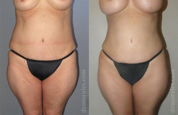 Before & After Liposuction Case 423 View 1 View in Houston, TX