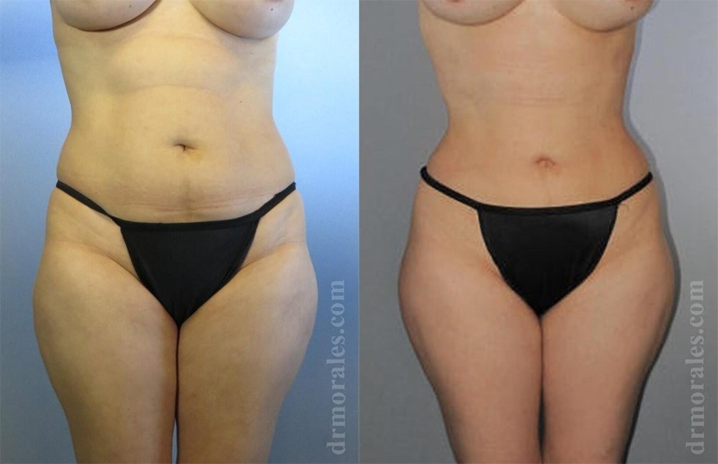 Before & After Liposuction Case 425 View 1 View in Houston, TX