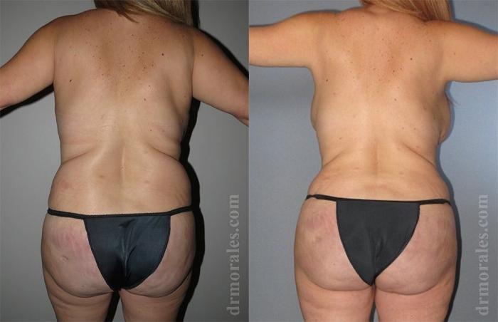 Before & After Liposuction Case 426 View 1 View in Houston, TX