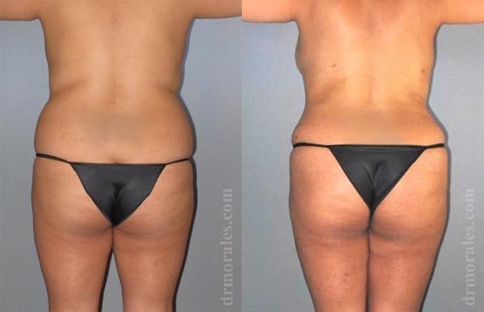Before & After Liposuction Case 427 View 1 View in Houston, TX