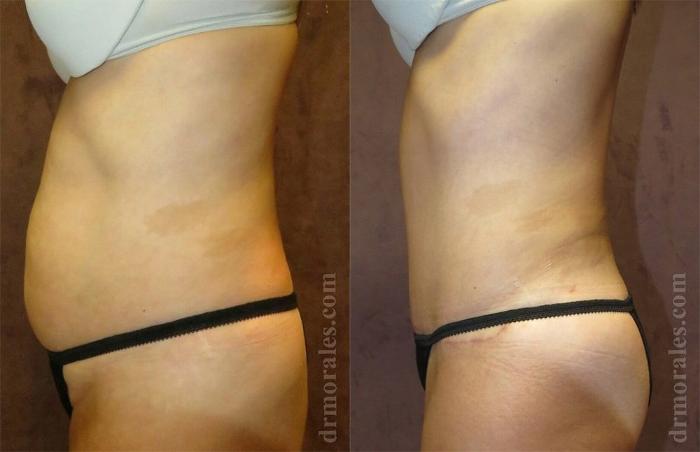 Before & After Liposuction Case 428 View 1 View in Houston, TX
