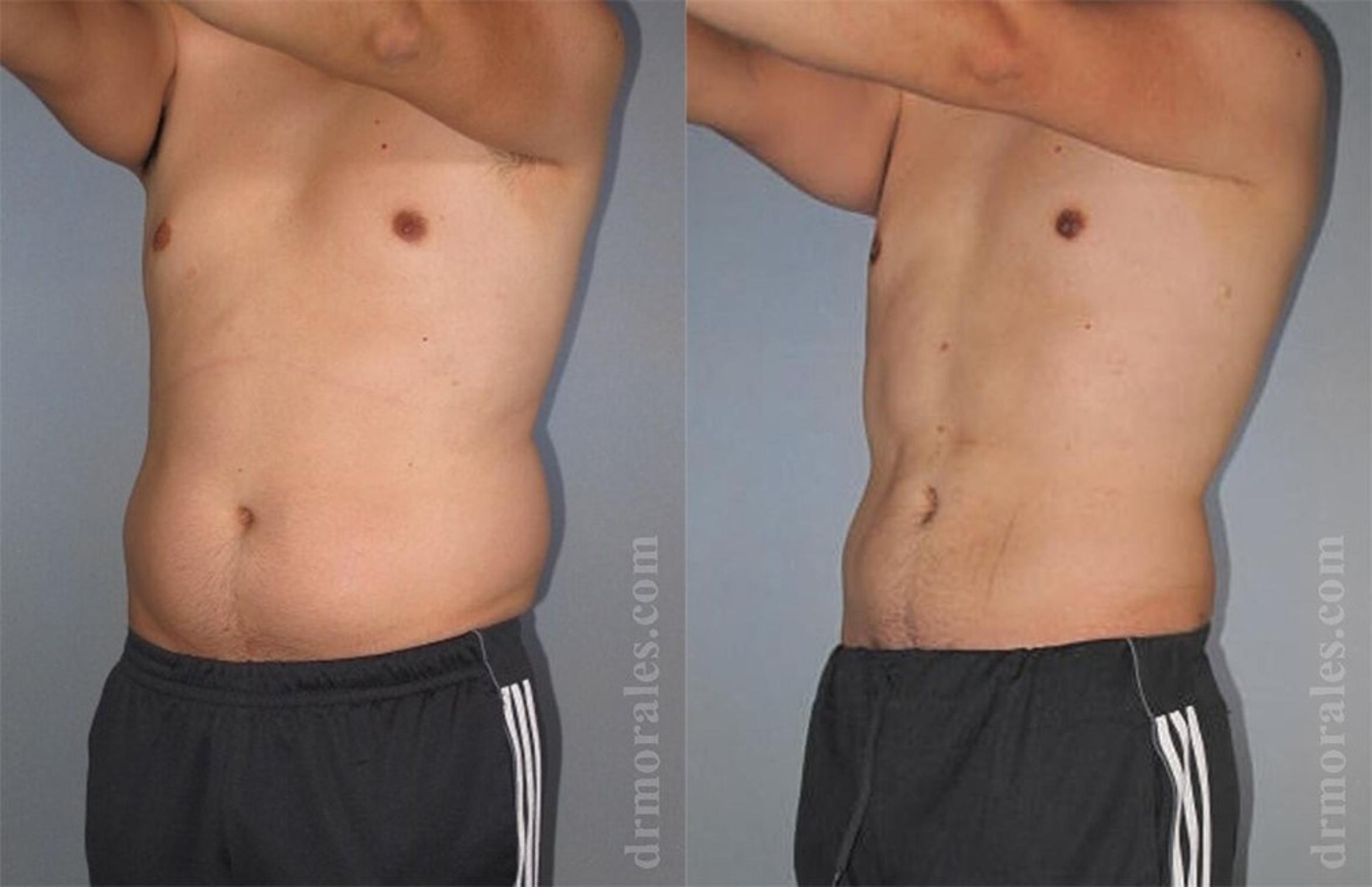 Before & After Liposuction Case 429 View 1 View in Houston, TX
