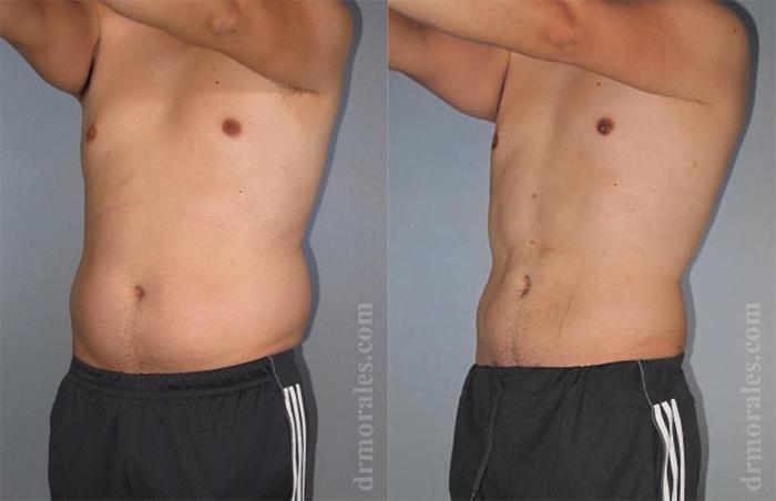 Before & After Liposuction Case 429 View 1 View in Houston, TX