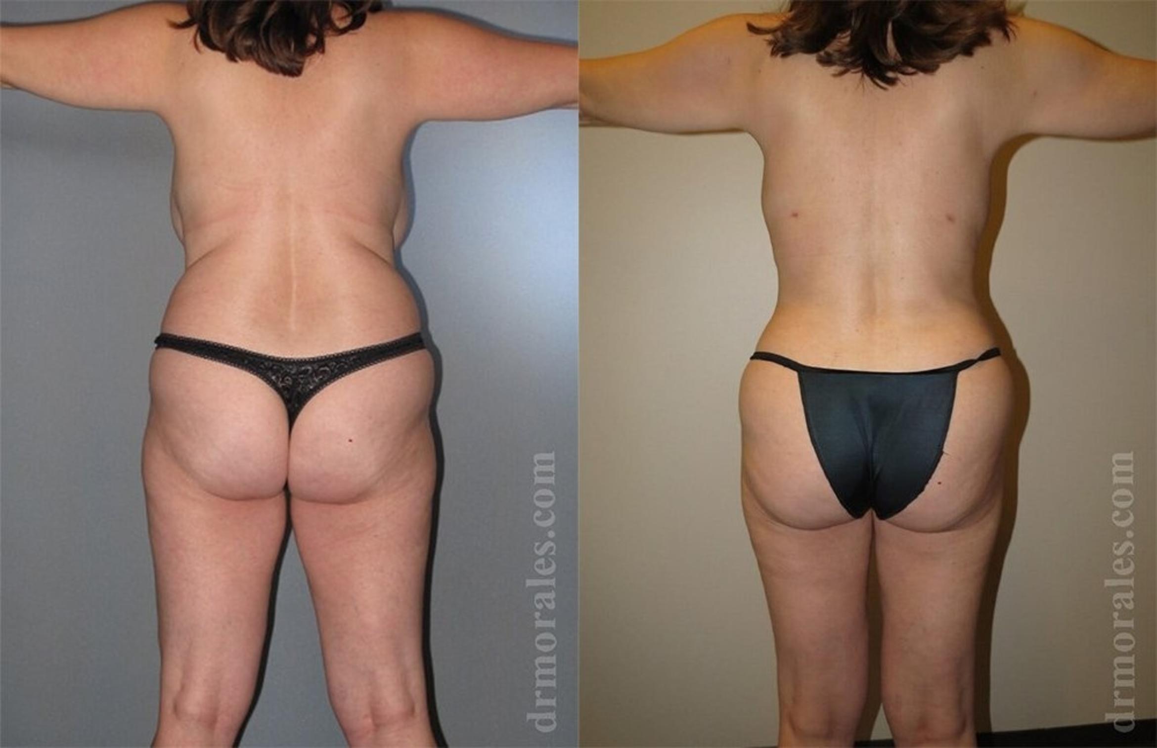 Before & After Liposuction Case 430 View 1 View in Houston, TX