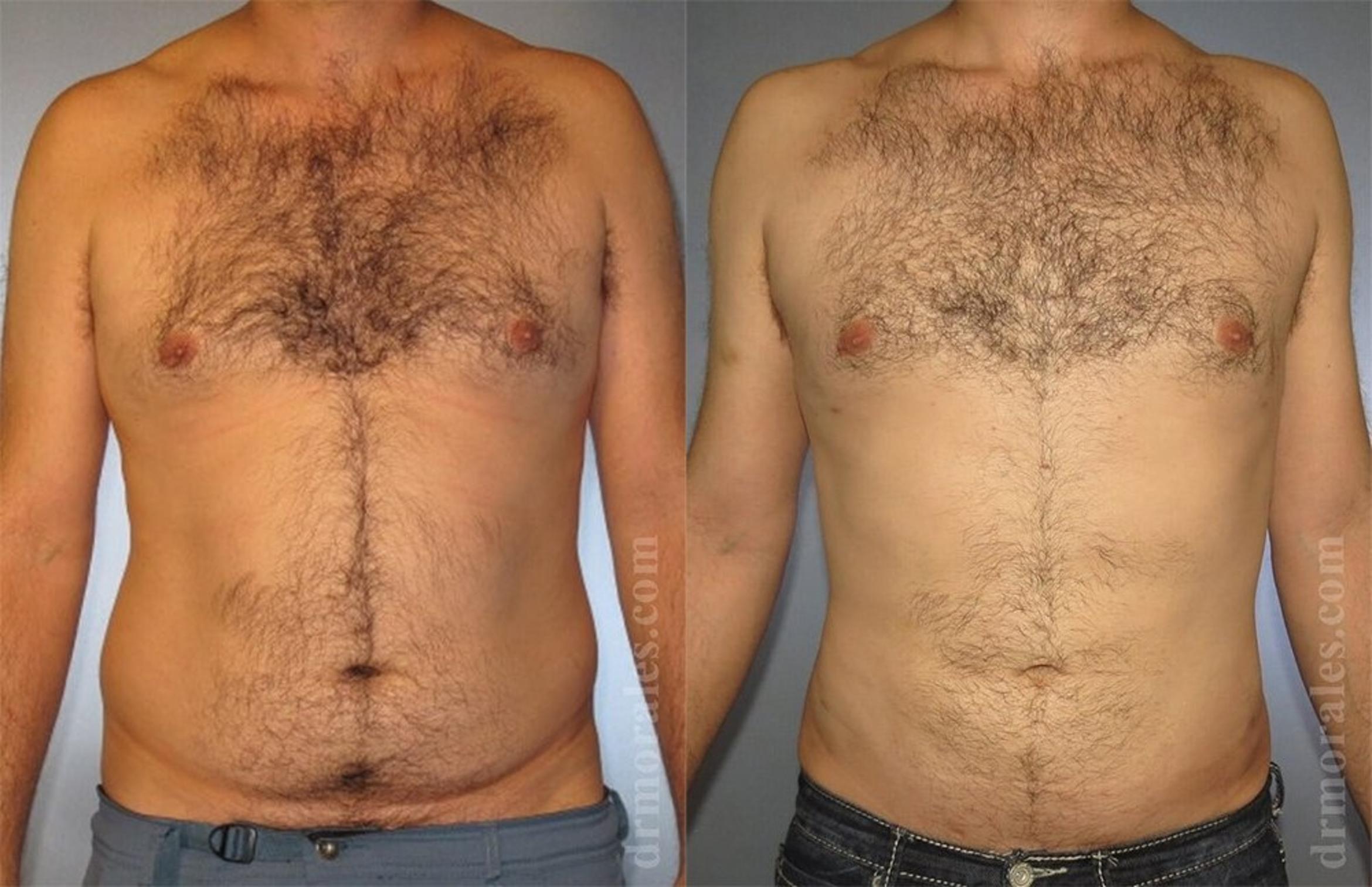 Before & After Liposuction Case 431 View 1 View in Houston, TX