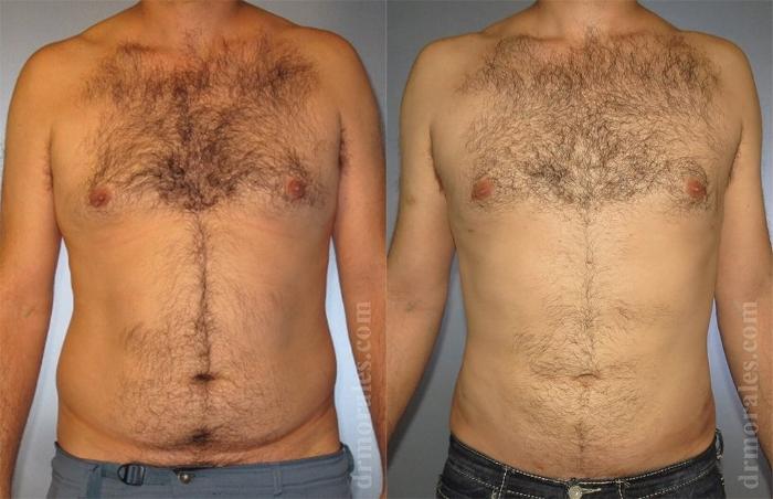 Before & After Liposuction Case 431 View 1 View in Houston, TX