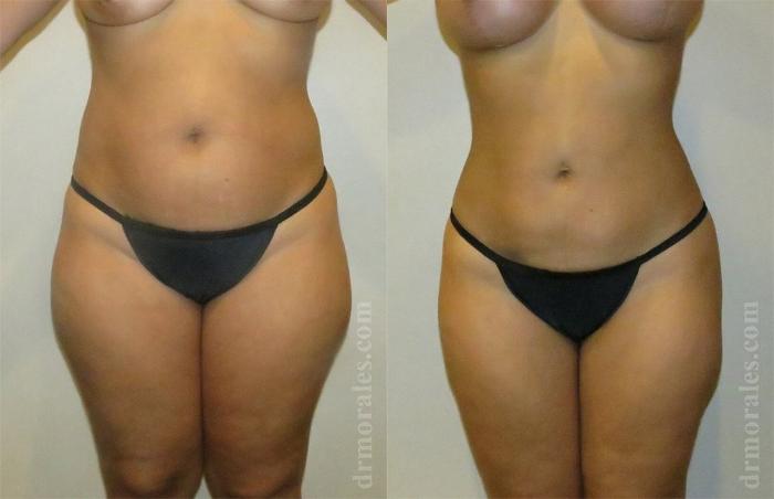 Before & After Liposuction Case 432 View 1 View in Houston, TX