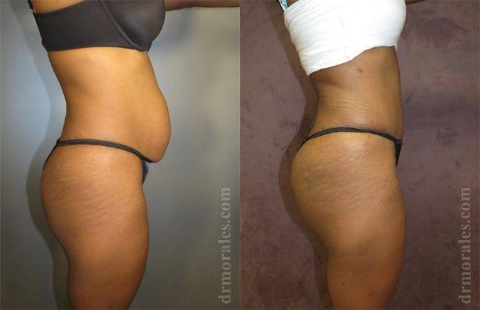 Before & After Tummy Tuck Case 433 View 1 View in Houston, TX