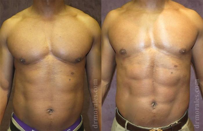 Before & After Liposuction Case 435 View 1 View in Houston, TX