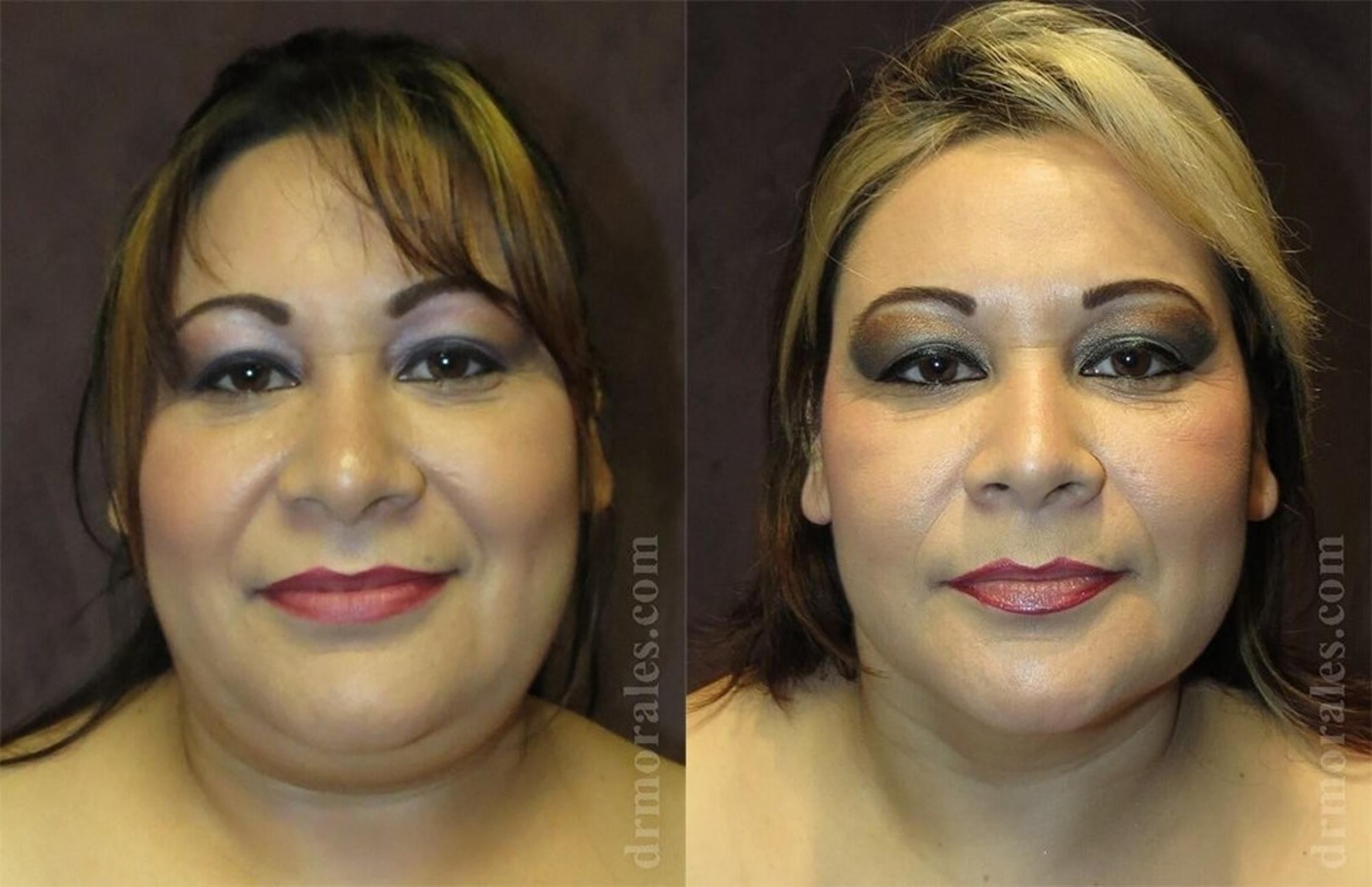 Before & After Liposuction Case 436 View 1 View in Houston, TX