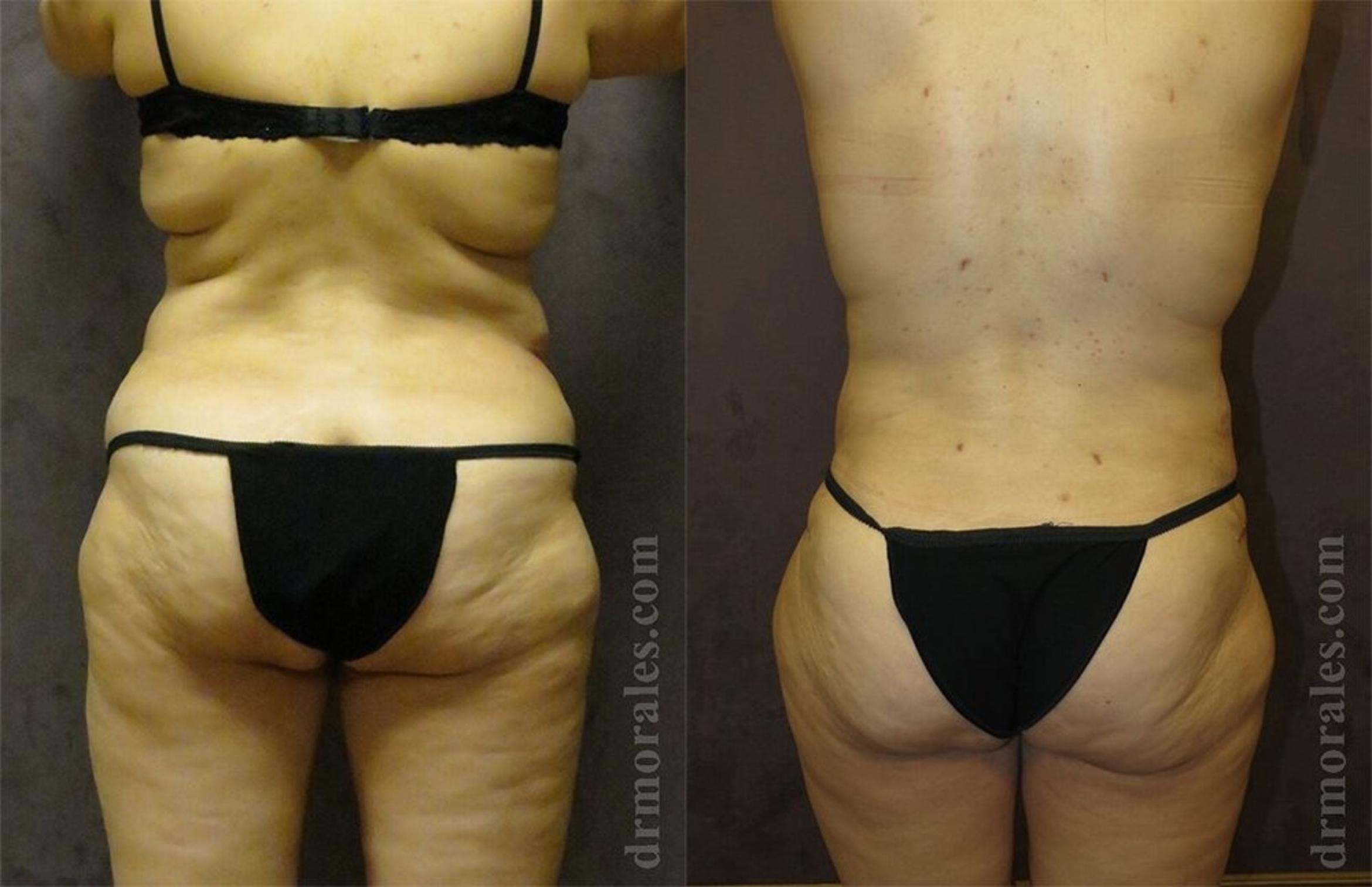 Before & After Liposuction Case 437 View 1 View in Houston, TX