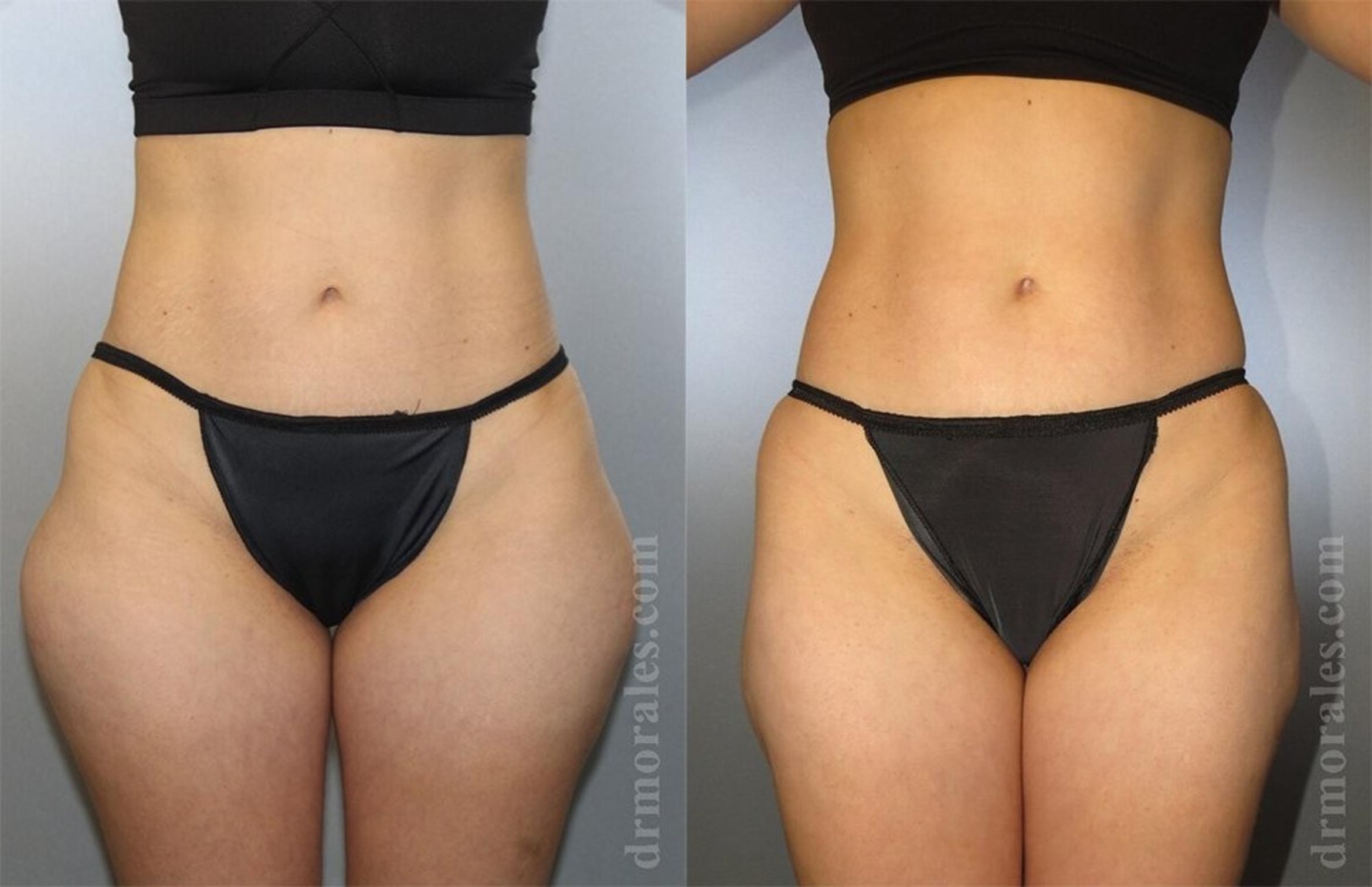 Before & After Liposuction Case 438 View 1 View in Houston, TX