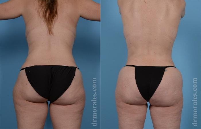 Before & After Liposuction Case 439 View 1 View in Houston, TX