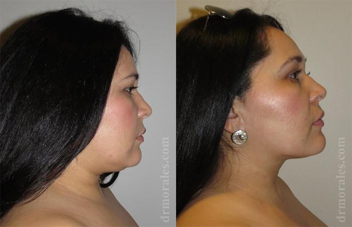 Before & After Liposuction Case 440 View 1 View in Houston, TX