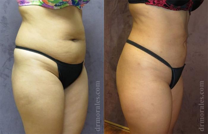 Before & After Liposuction Case 441 View 1 View in Houston, TX