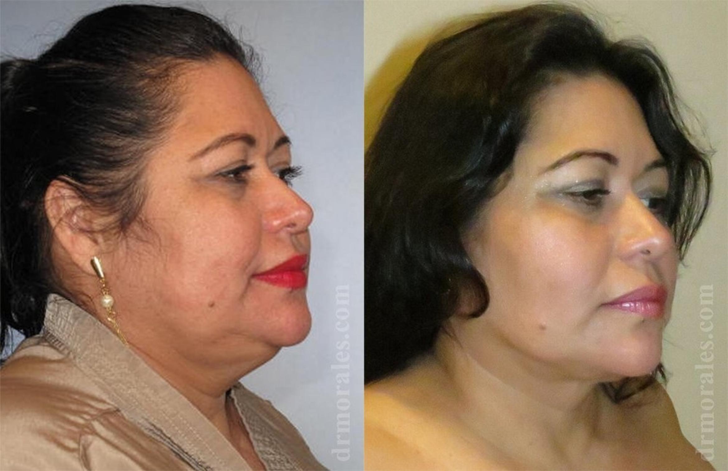 Before & After Liposuction Case 442 View 1 View in Houston, TX