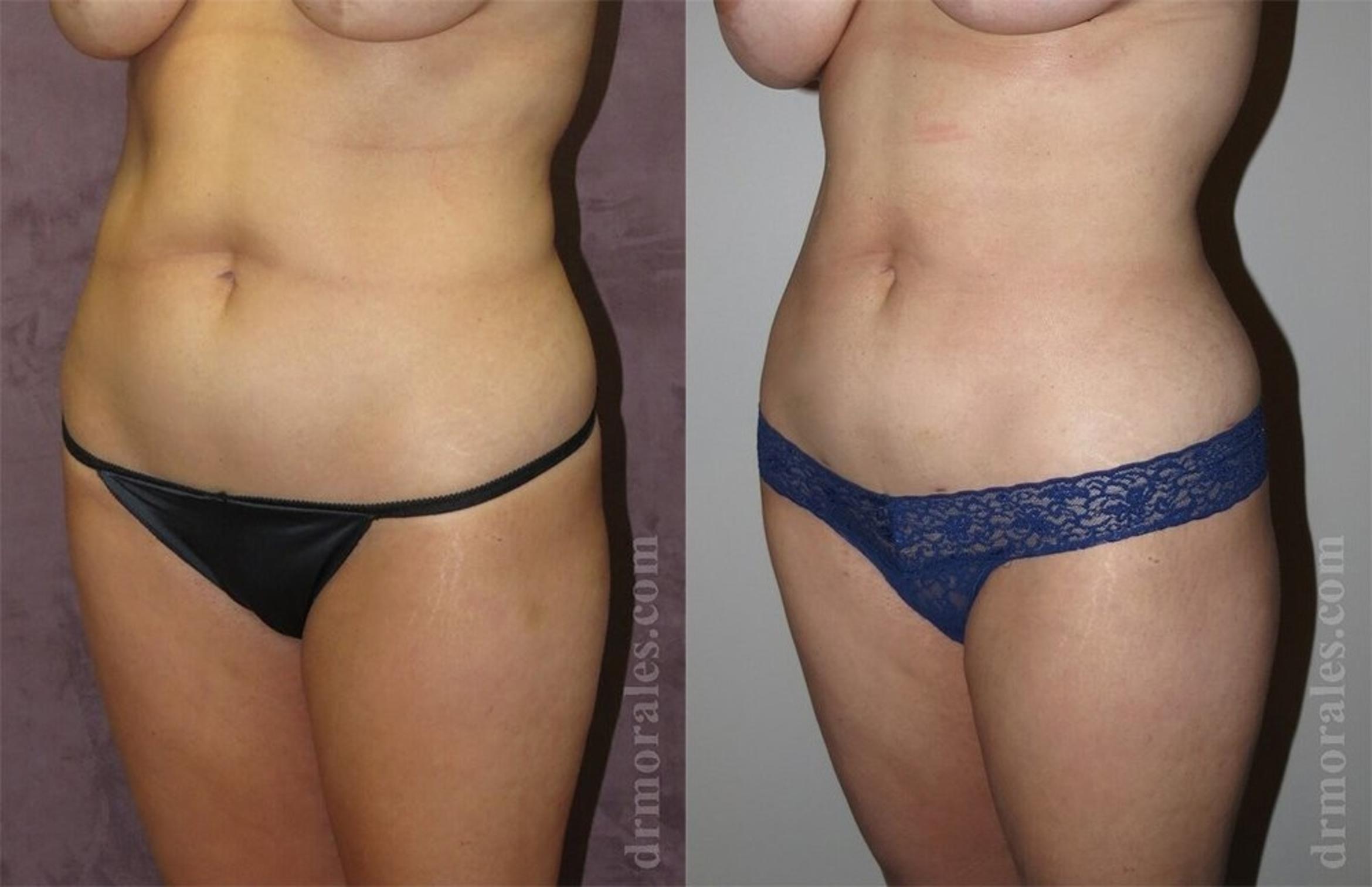 Before & After Liposuction Case 445 View 1 View in Houston, TX