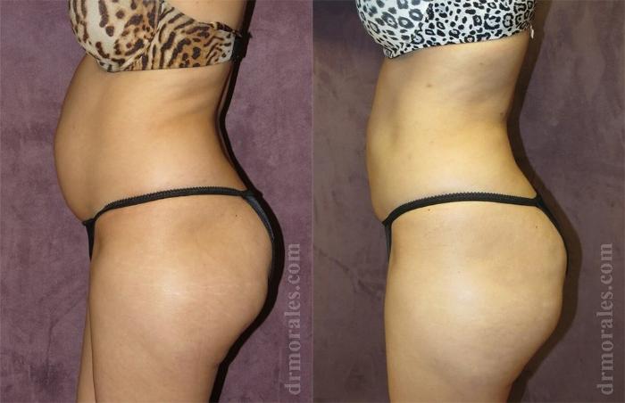 Before & After Liposuction Case 447 View 1 View in Houston, TX