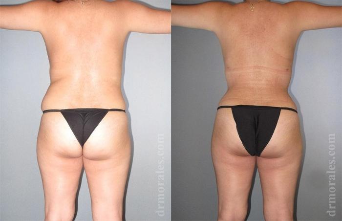 Before & After Liposuction Case 448 View 1 View in Houston, TX